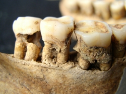 Teeth with plaque